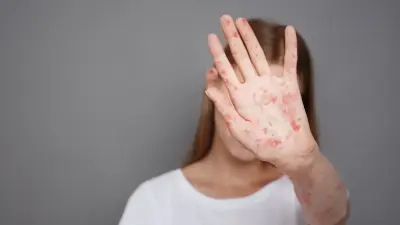 Более 230 случаев кори зарегистрировали в Астане за первые недели 2026 года