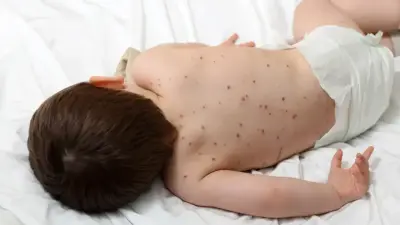  Қызылшамен ауырғандардың 78 пайызы екпе алмаған. Ата-аналар неге вакцинаға қарсы?